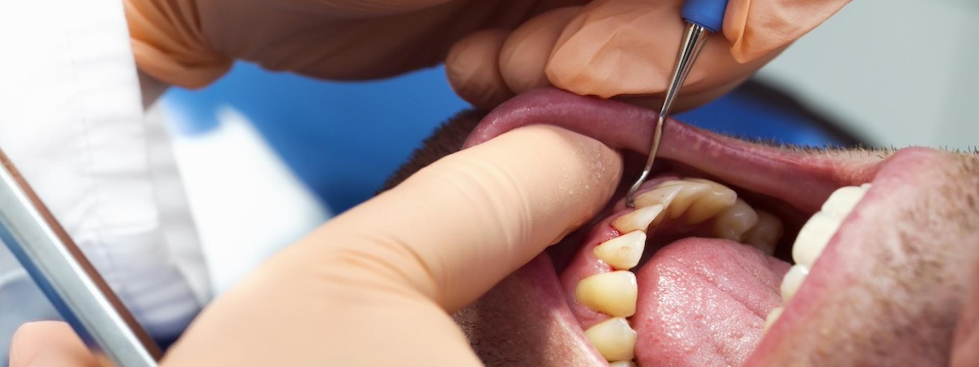 The Stages of Periodontitis: Understanding the Progression